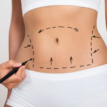 Liposuction Treatment