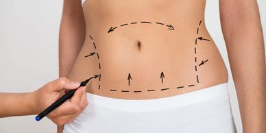 Body contouring and tummy tuck drawings
