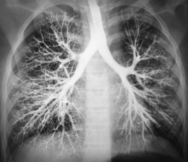 Lungs and Asthma