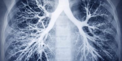 Chest X-ray showing detailed lung and bronchial tree structures.