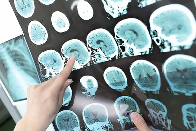 Penetrating Brain Injury Lawsuits