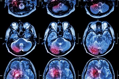 Hypoxic Brain Injury Lawsuits