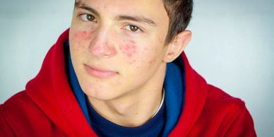 acne treatments