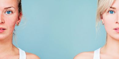 Side-by-side comparison of a woman's skin before and after treatment, showing clear improvement.