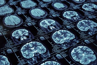 coronal MRI brain imaging in neuropsychiatry 