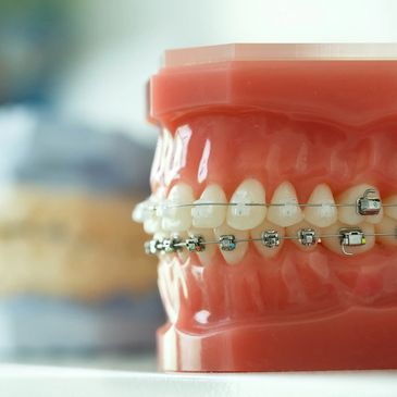 Clarity Braces with a ceramic upper and lower metal installation. Two Clarity options!