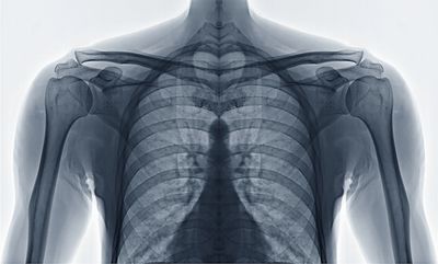 X-ray showing upper back anatomy for patient with upper back pain