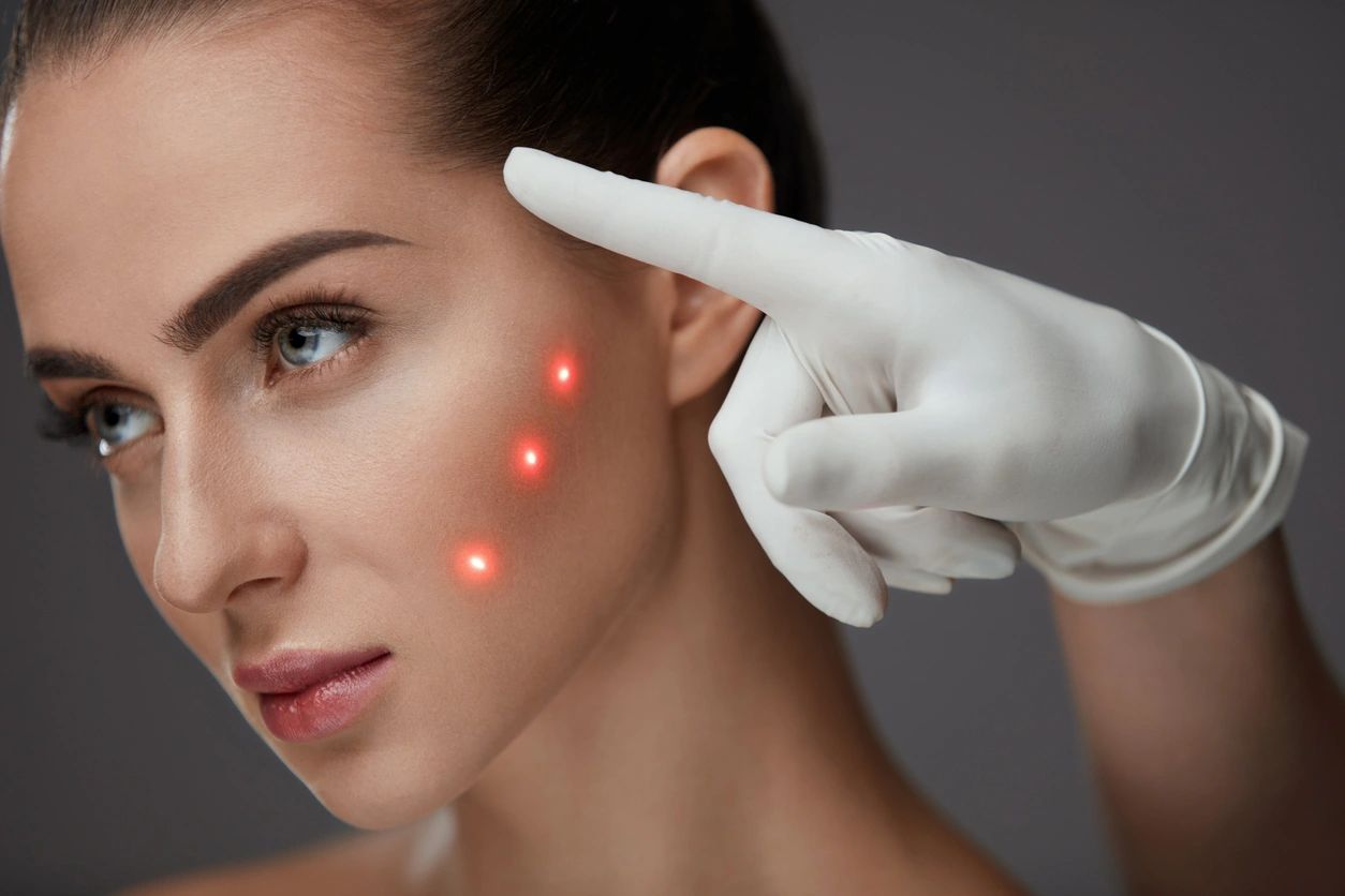 8 BENEFICIOS DE LA LUZ PULSADA INTENSA EN OFTALMOLOGÍA Y MEDICINA ESTÉTICA  FACIAL