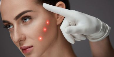 Laser treatment on woman's facial acne spots.