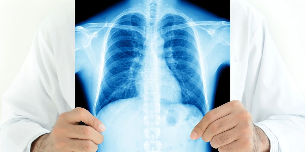 CXR standard for initial work permit medical