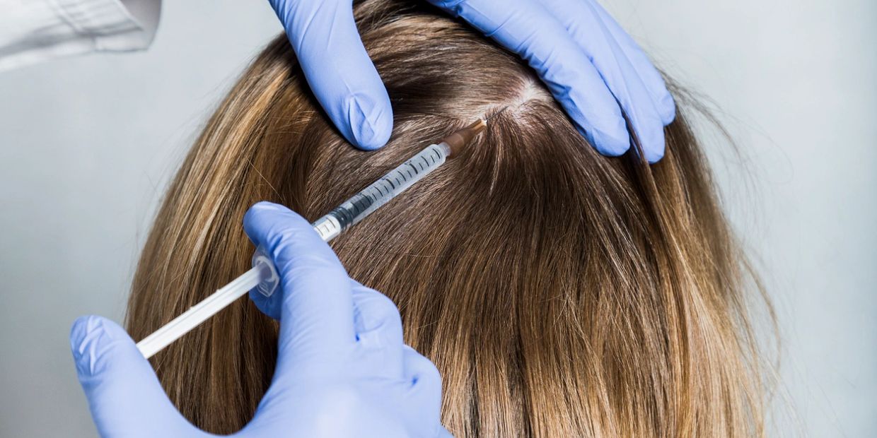 Injection being administered into a person's scalp with gloved hands.