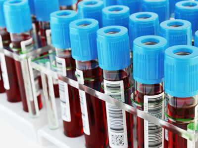 Mesothelioma Blood Test Biomarkers