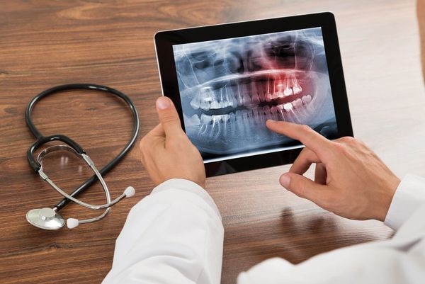Root canals, extractions, pulling teeth, endo, endodontics