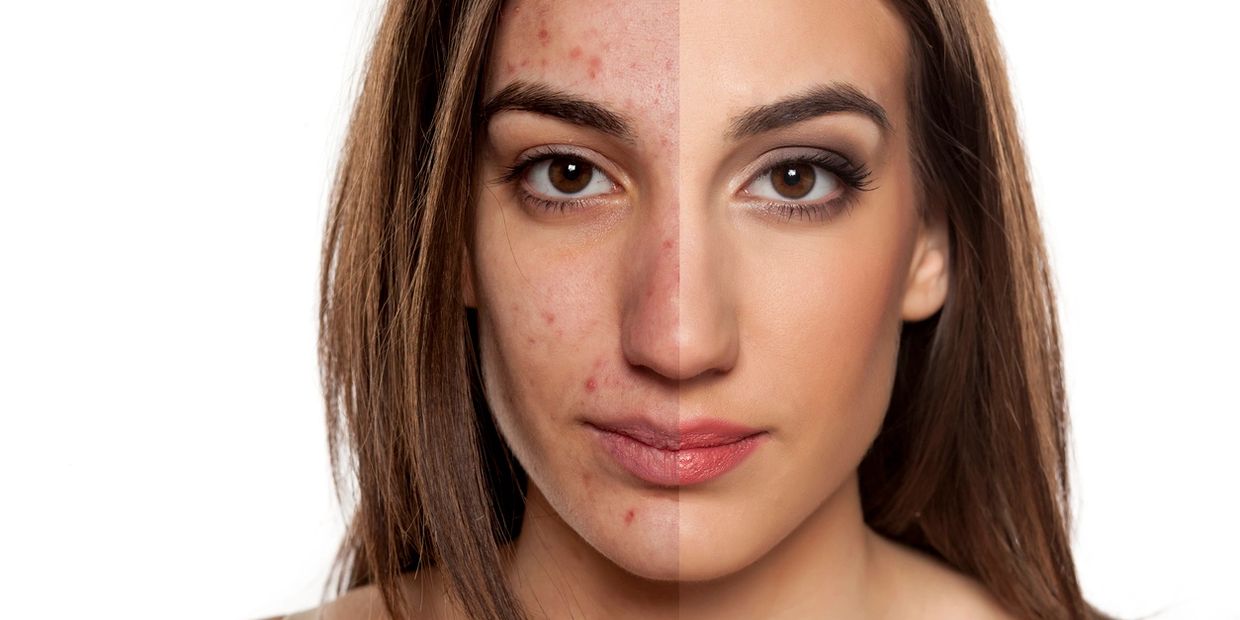 Acne is a skin condition characterised by red pimples on the skin, especially on the face, due to in